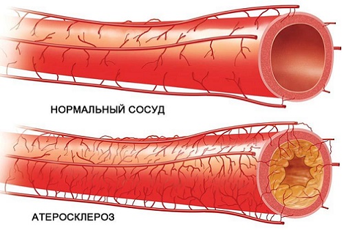 Атеросклероз - причина шума в голове
