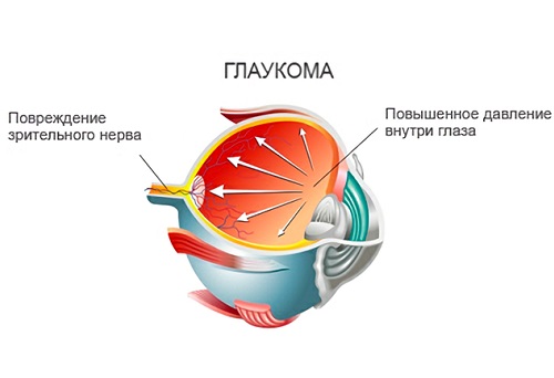 Глаукома - причина боли в голове и глазах