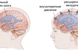 Схема внутричерепного давления