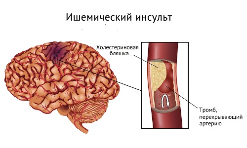 Ишемический инсульт - разновидность цереброваскулярной патологии