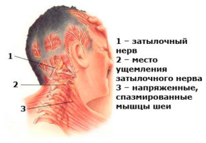 Защемление затылочных нервов